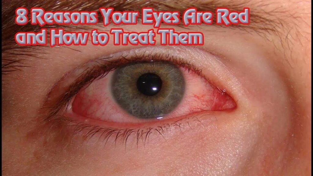 8 Reasons Why Your Eyes are Red