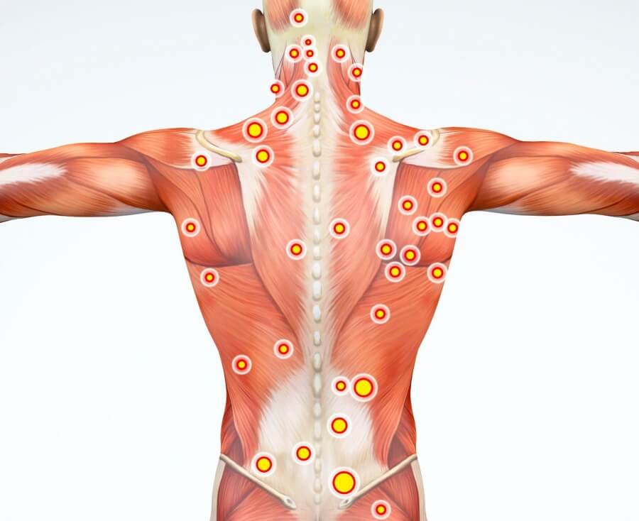 Spine Muscles in Pain