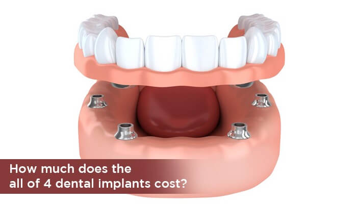 Why you should consider the all-on-4 dental implants