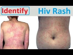 How to know if you have HIV rashes?