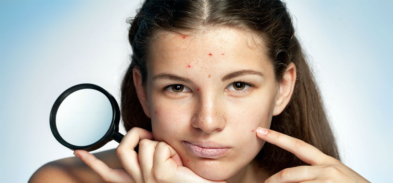 5 Excellent Home Remedies For Blackheads