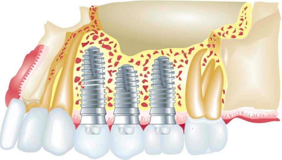 Progress in Dental Implants and Nanotechnology