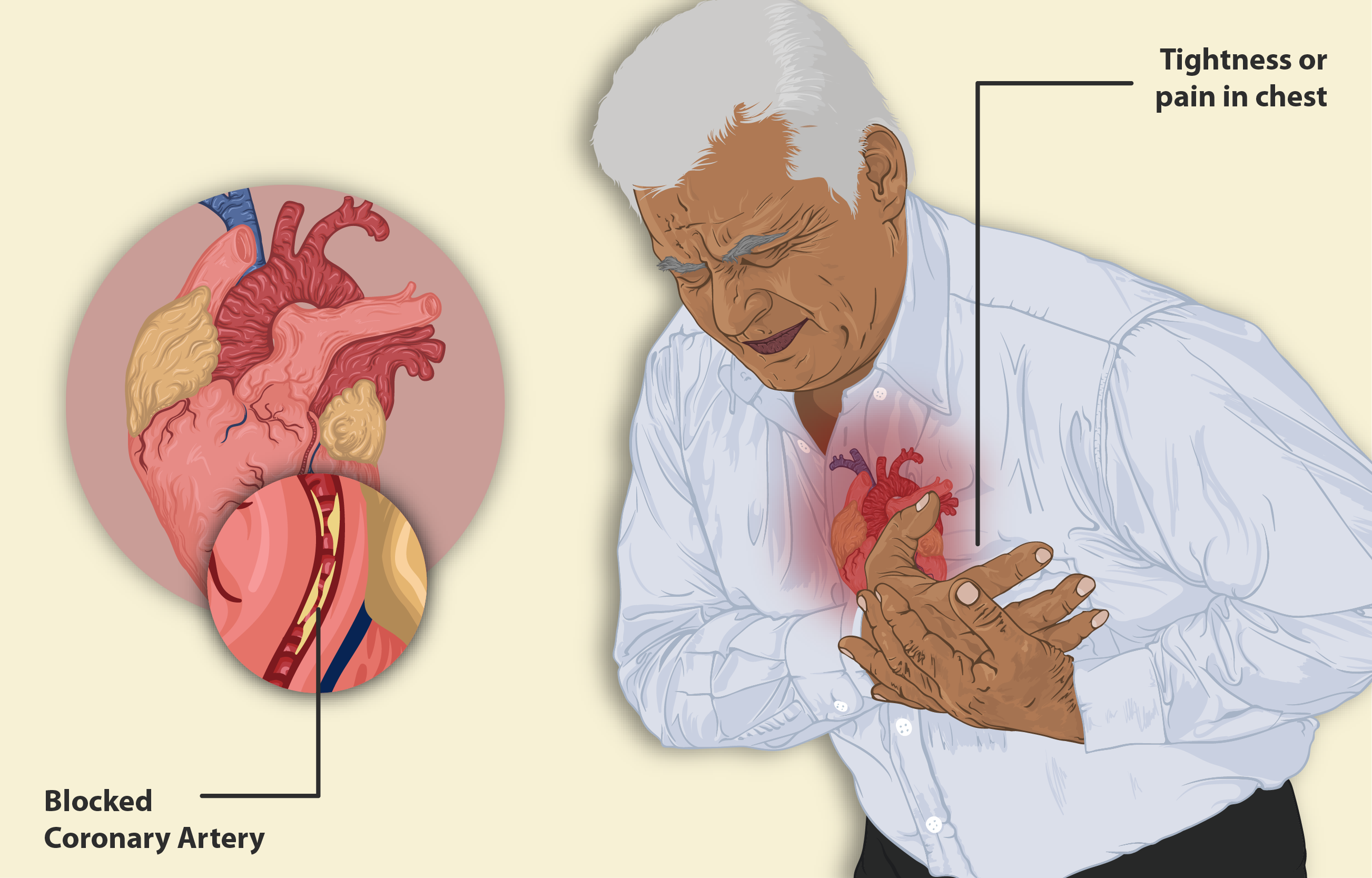 Signs of a Heart attack