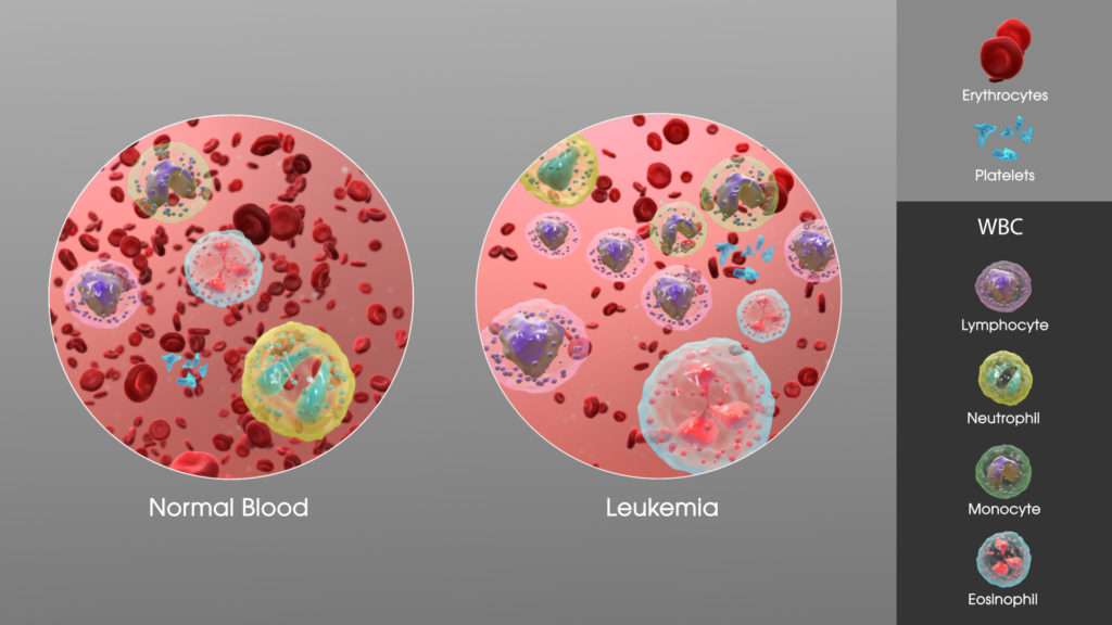 leukemia causes