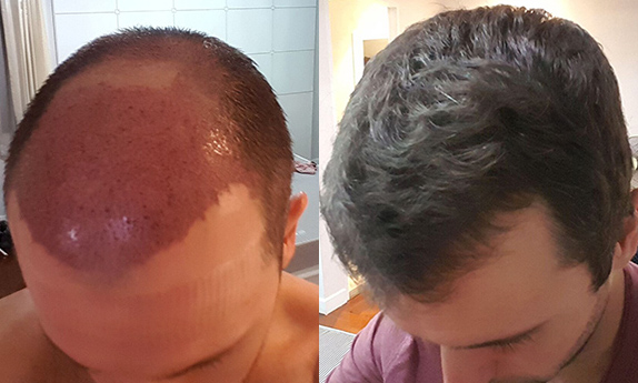 Recover from Hair Transplant