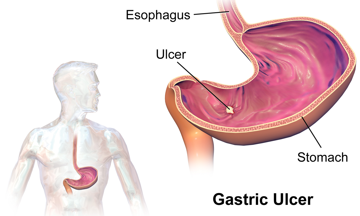 peptic ulcer symptoms