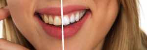 How to Whiten Your Teeth With Baking Soda at Home