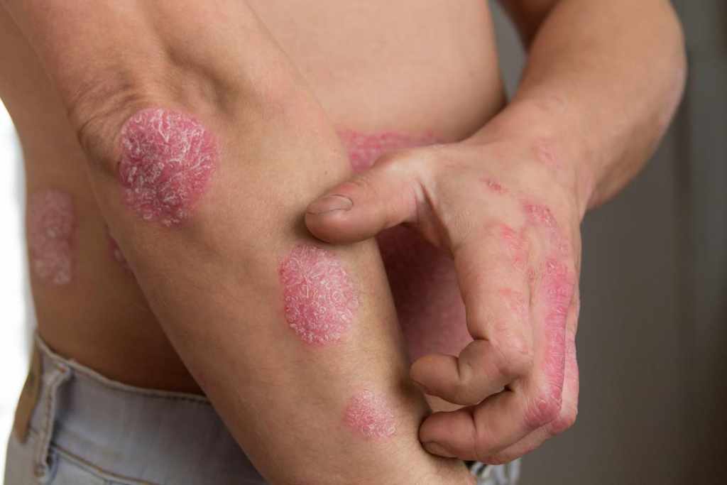 What Best Treatments Psoriasis