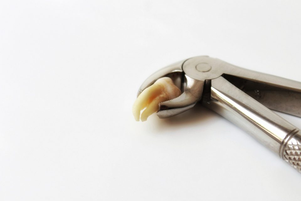 Food Stuck in Wisdom Tooth Hole How to Get It