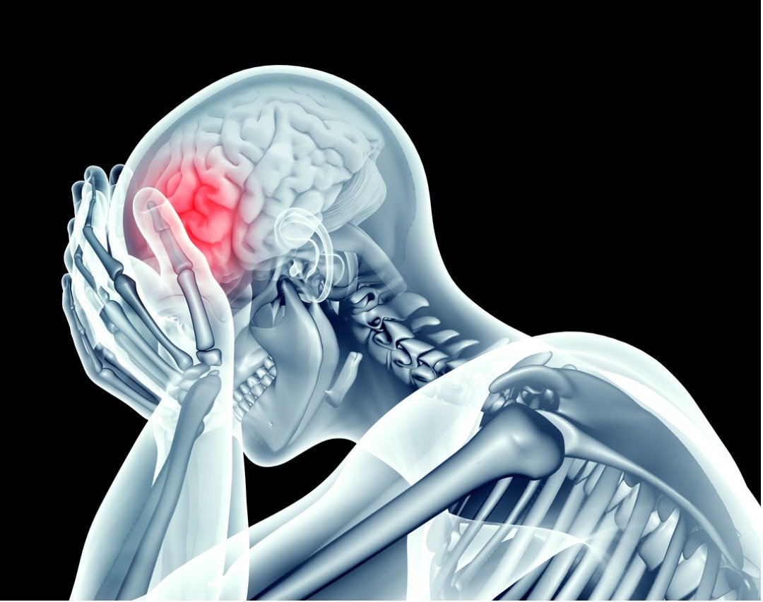 What Is Post Concussion Syndrome