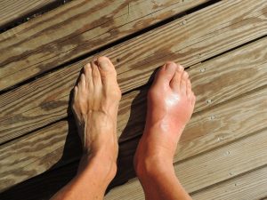 Inflammation due to Bone Spur in the Ankle